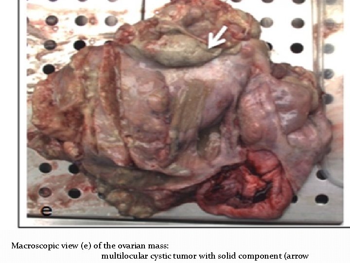 Macroscopic view (e) of the ovarian mass: multilocular cystic tumor with solid component (arrow