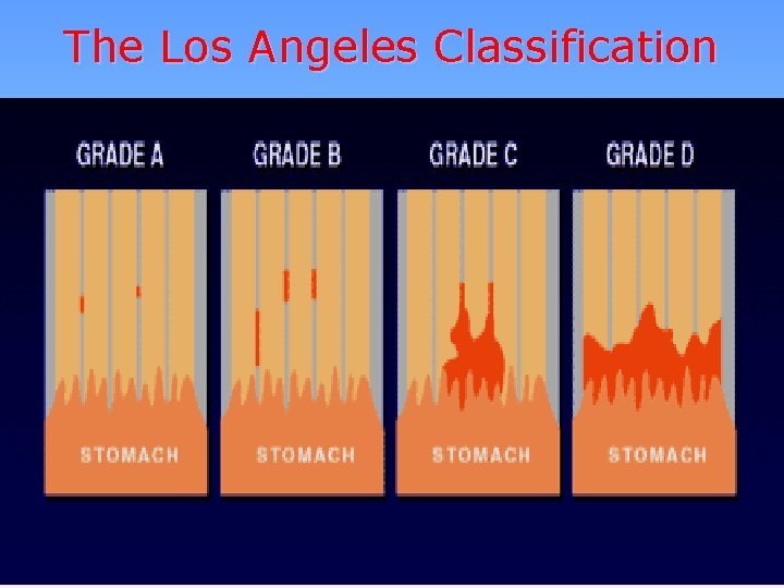 The Los Angeles Classification 
