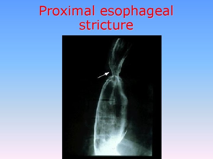Proximal esophageal stricture 