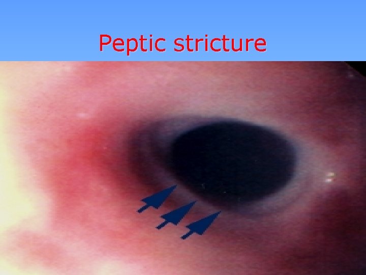 Peptic stricture 