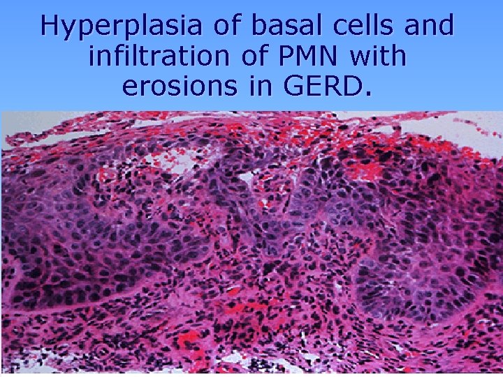 Hyperplasia of basal cells and infiltration of PMN with erosions in GERD. 