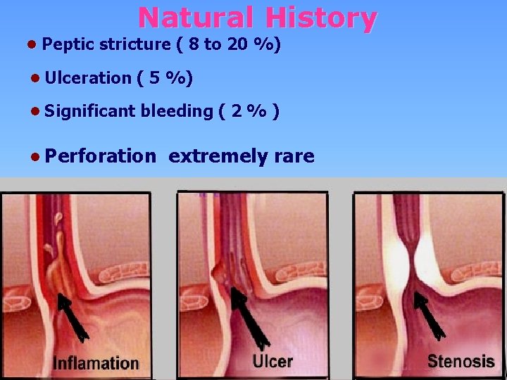 Natural History ● Peptic stricture ( 8 to 20 %) ● Ulceration ( 5