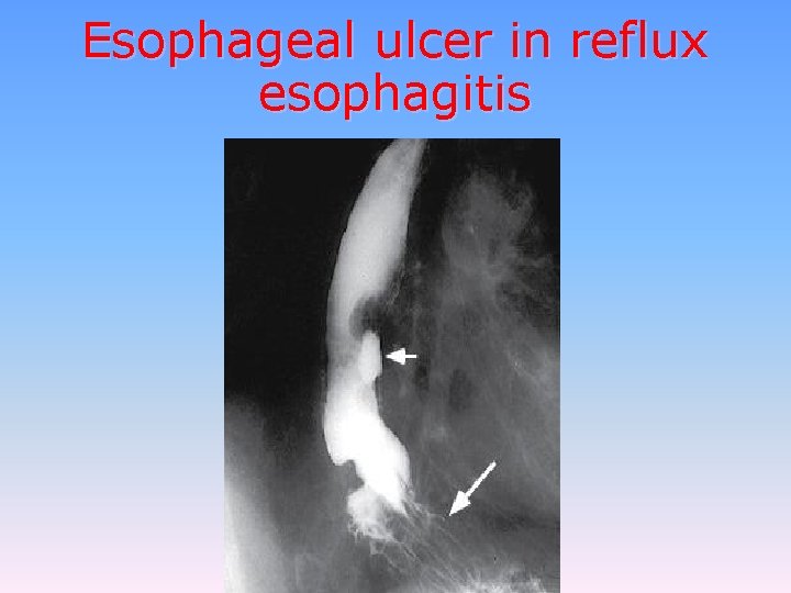 Esophageal ulcer in reflux esophagitis 