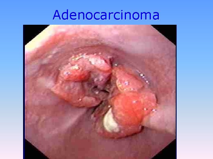 Adenocarcinoma 