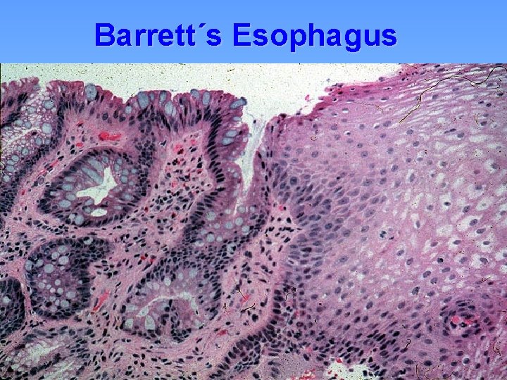 Barrett´s Esophagus 