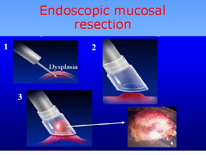 Endoscopic mucosal resection 