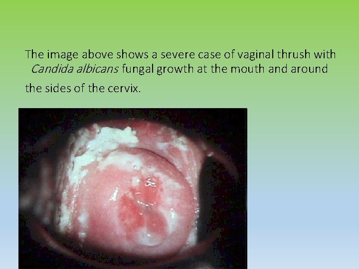The image above shows a severe case of vaginal thrush with Candida albicans fungal