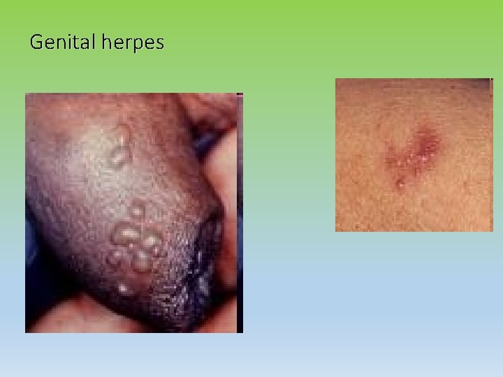 Genital herpes 