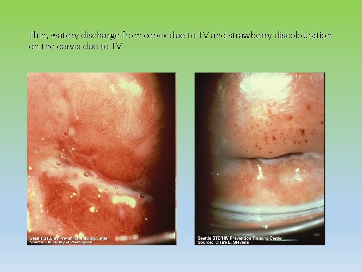 Thin, watery discharge from cervix due to TV and strawberry discolouration on the cervix
