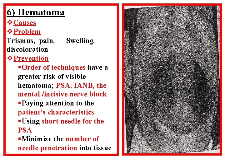 6) Hematoma v. Causes v. Problem Trismus, pain, Swelling, discoloration v. Prevention §Order of