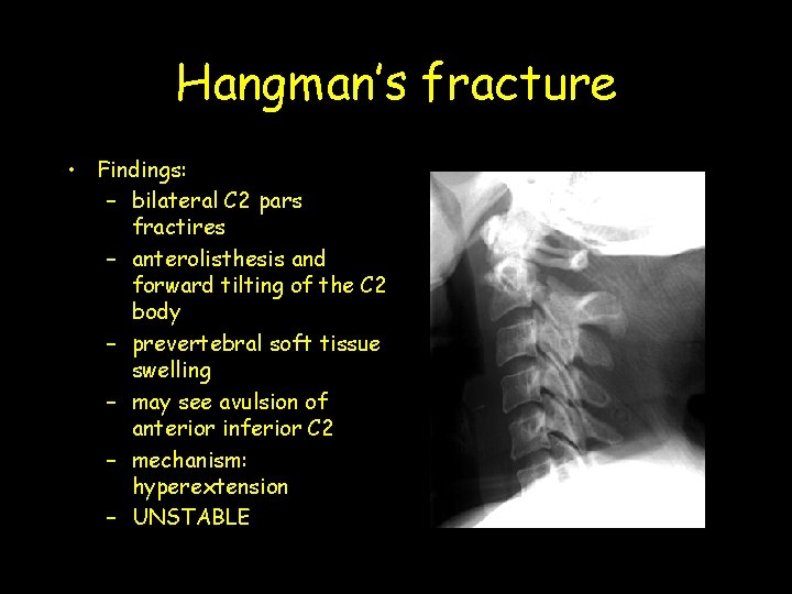 Hangman’s fracture • Findings: – bilateral C 2 pars fractires – anterolisthesis and forward