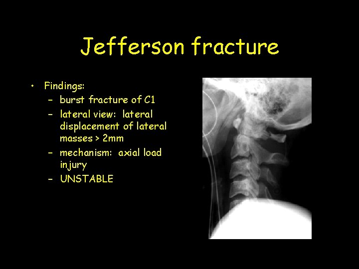 Jefferson fracture • Findings: – burst fracture of C 1 – lateral view: lateral