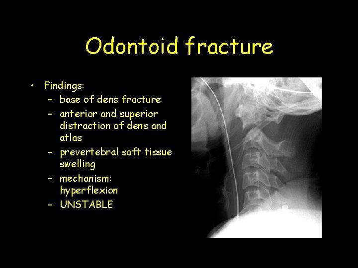 Odontoid fracture • Findings: – base of dens fracture – anterior and superior distraction