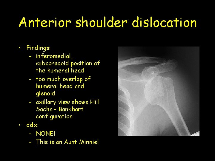 Anterior shoulder dislocation • Findings: – inferomedial, subcoracoid position of the humeral head –