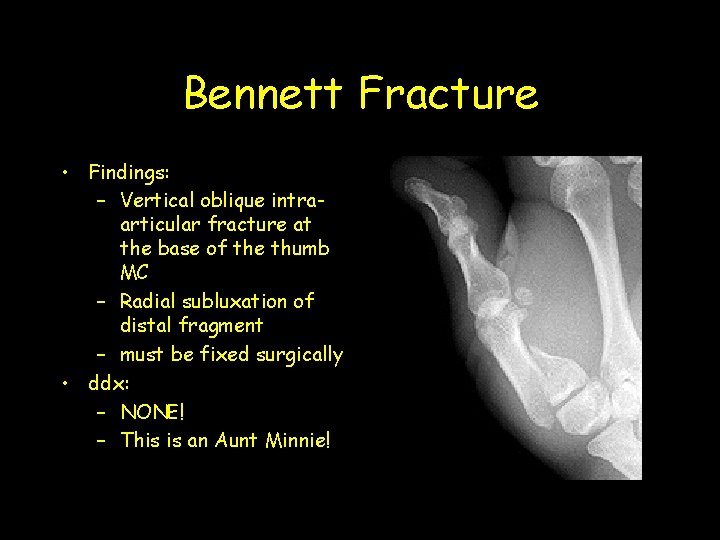 Bennett Fracture • Findings: – Vertical oblique intraarticular fracture at the base of the