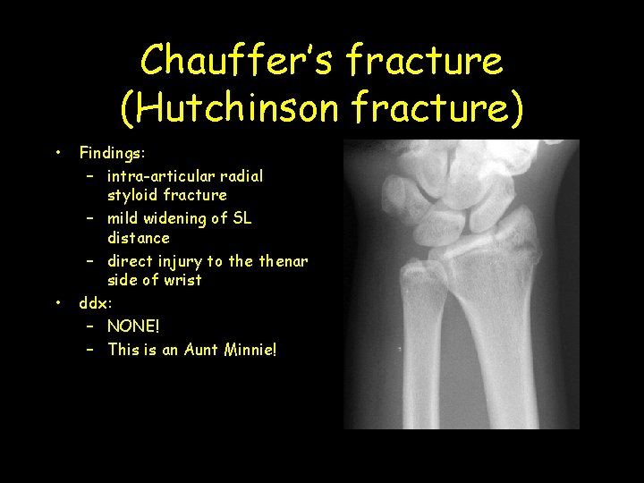 Chauffer’s fracture (Hutchinson fracture) • • Findings: – intra-articular radial styloid fracture – mild