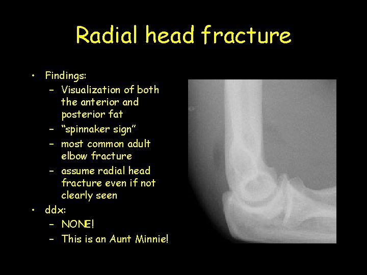 Radial head fracture • Findings: – Visualization of both the anterior and posterior fat