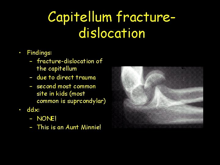 Capitellum fracturedislocation • Findings: – fracture-dislocation of the capitellum – due to direct trauma