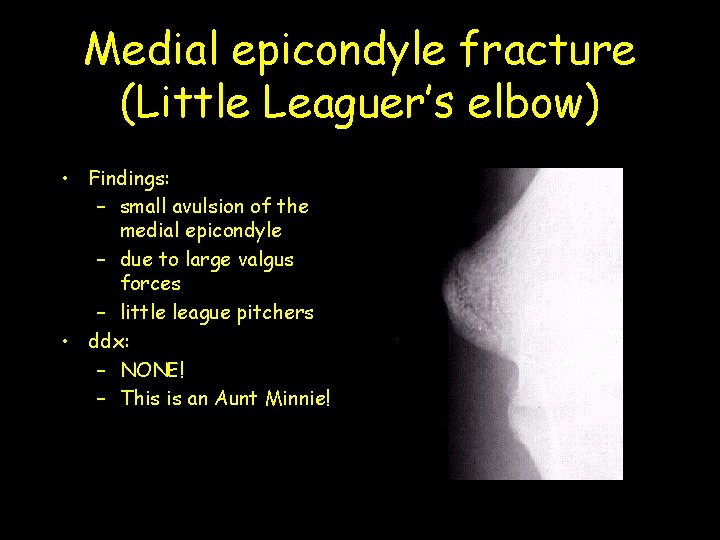 Medial epicondyle fracture (Little Leaguer’s elbow) • Findings: – small avulsion of the medial