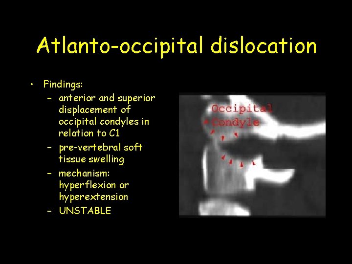 Atlanto-occipital dislocation • Findings: – anterior and superior displacement of occipital condyles in relation