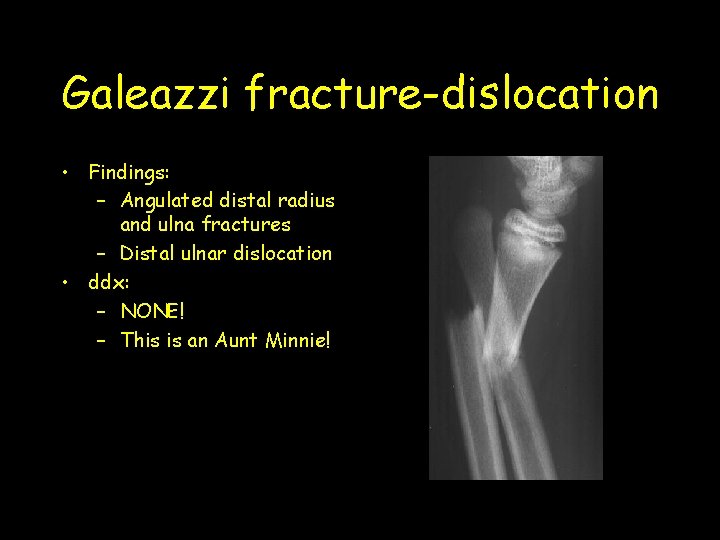 Galeazzi fracture-dislocation • Findings: – Angulated distal radius and ulna fractures – Distal ulnar