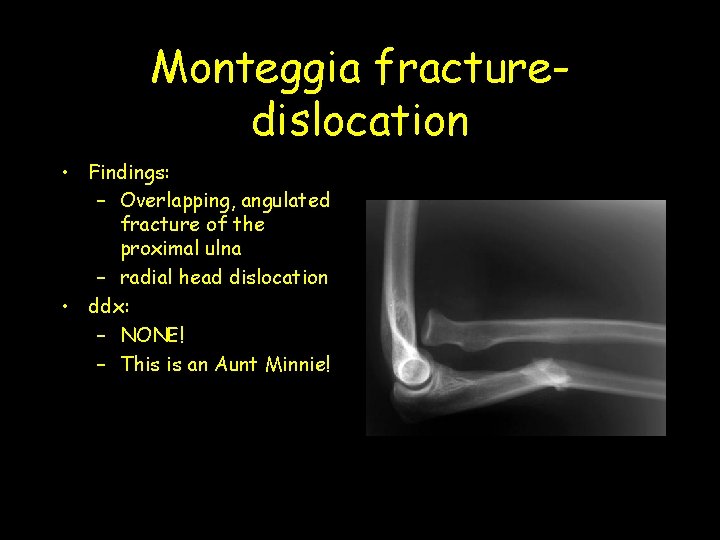 Monteggia fracturedislocation • Findings: – Overlapping, angulated fracture of the proximal ulna – radial