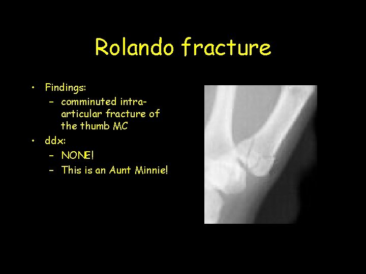 Rolando fracture • Findings: – comminuted intraarticular fracture of the thumb MC • ddx: