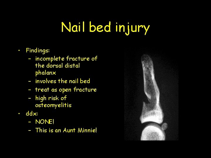 Nail bed injury • Findings: – incomplete fracture of the dorsal distal phalanx –