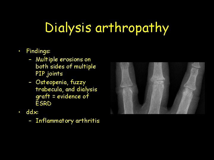 Dialysis arthropathy • Findings: – Multiple erosions on both sides of multiple PIP joints