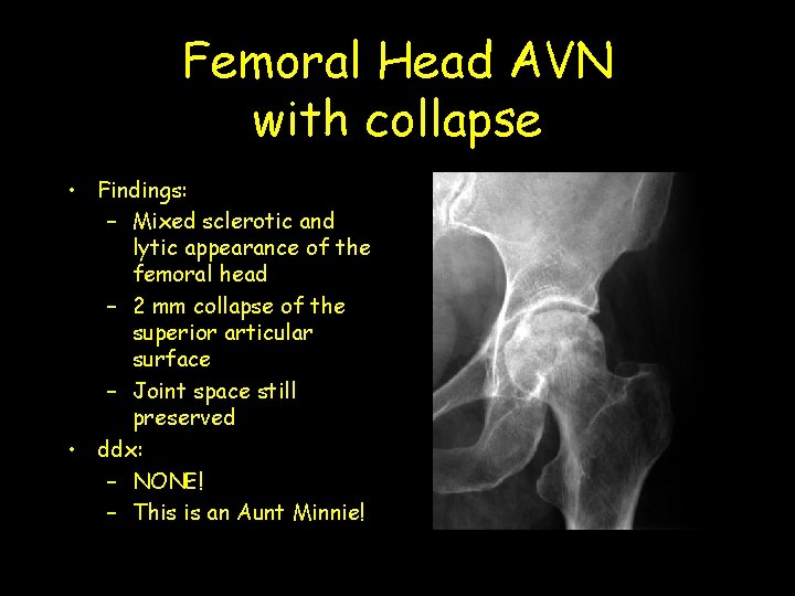 Femoral Head AVN with collapse • Findings: – Mixed sclerotic and lytic appearance of