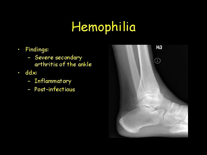 Hemophilia • Findings: – Severe secondary arthritis of the ankle • ddx: – Inflammatory