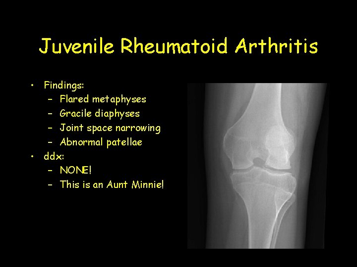 Juvenile Rheumatoid Arthritis • Findings: – Flared metaphyses – Gracile diaphyses – Joint space