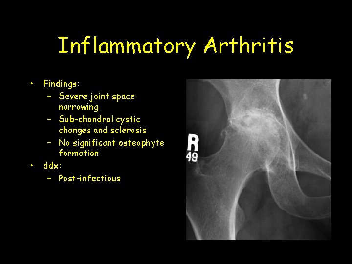 Inflammatory Arthritis • • Findings: – Severe joint space narrowing – Sub-chondral cystic changes