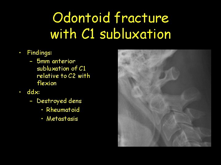 Odontoid fracture with C 1 subluxation • Findings: – 5 mm anterior subluxation of