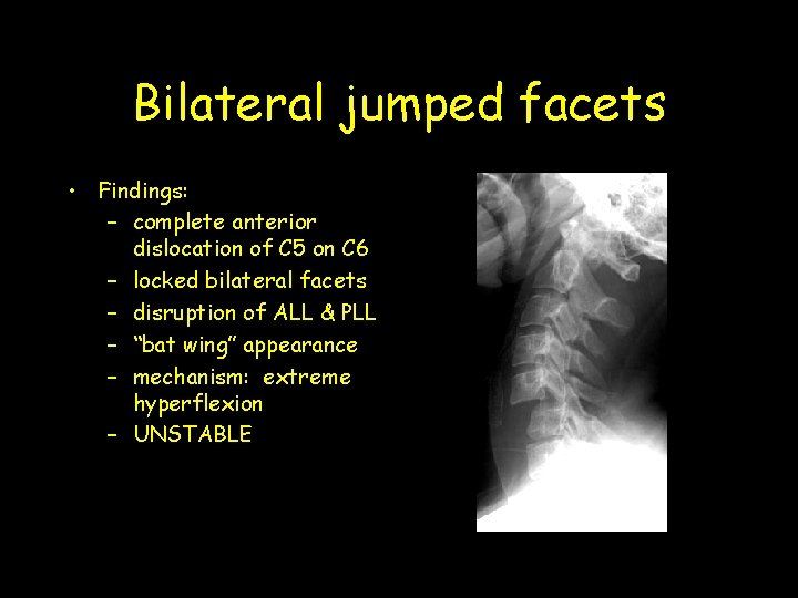 Bilateral jumped facets • Findings: – complete anterior dislocation of C 5 on C