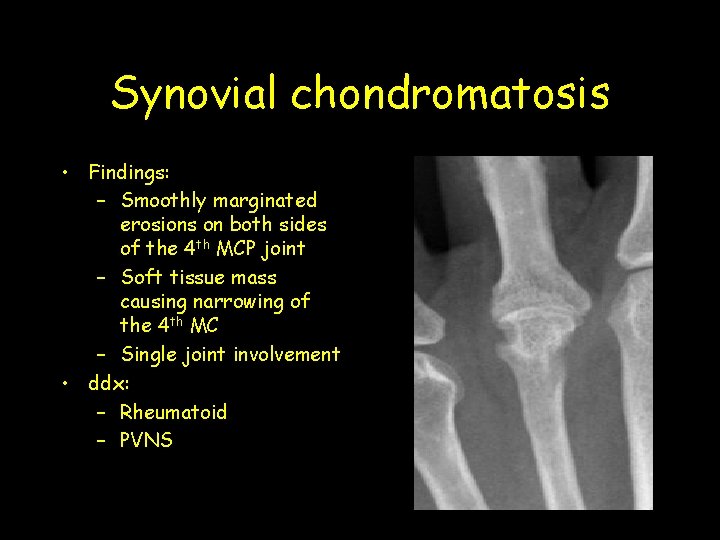 Synovial chondromatosis • Findings: – Smoothly marginated erosions on both sides of the 4