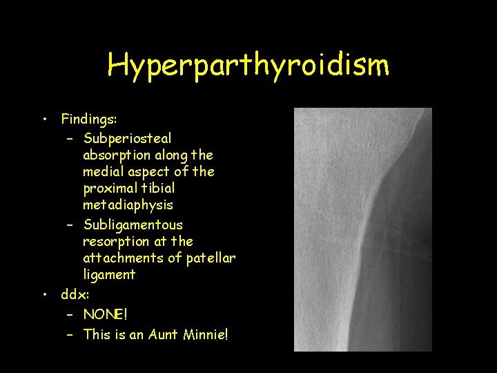 Hyperparthyroidism • Findings: – Subperiosteal absorption along the medial aspect of the proximal tibial