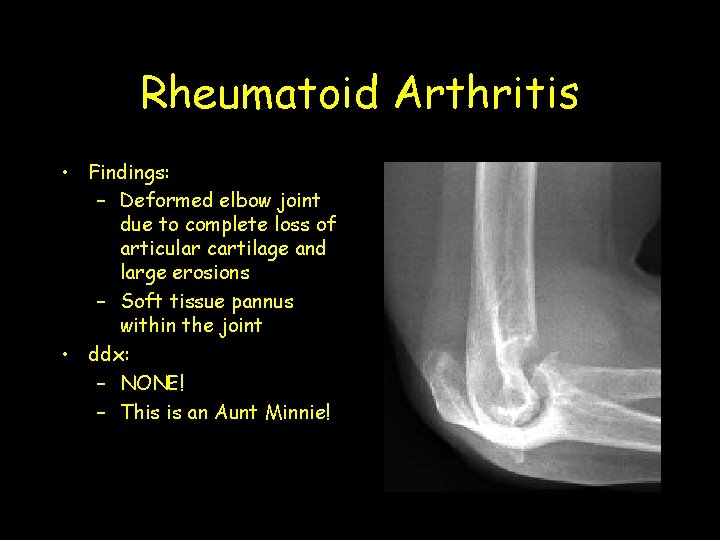 Rheumatoid Arthritis • Findings: – Deformed elbow joint due to complete loss of articular