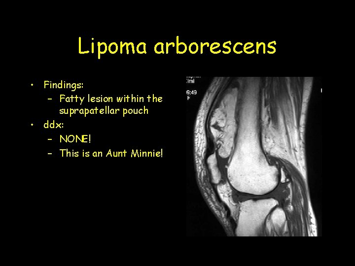 Lipoma arborescens • Findings: – Fatty lesion within the suprapatellar pouch • ddx: –