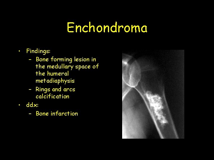 Enchondroma • Findings: – Bone forming lesion in the medullary space of the humeral