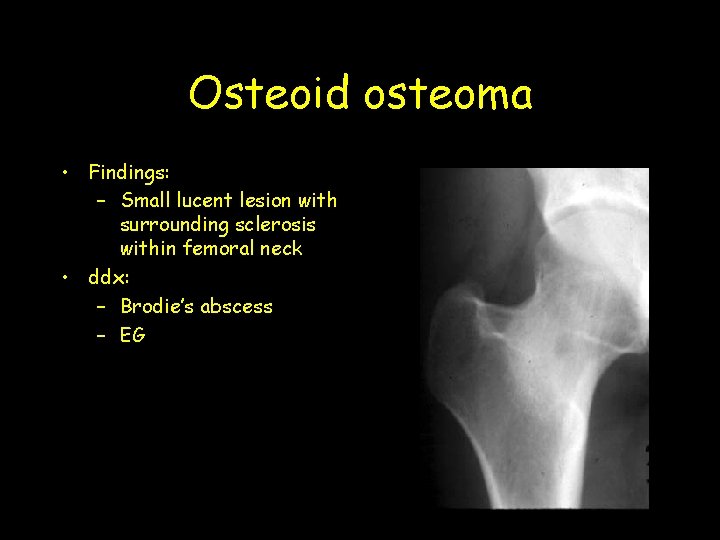 Osteoid osteoma • Findings: – Small lucent lesion with surrounding sclerosis within femoral neck