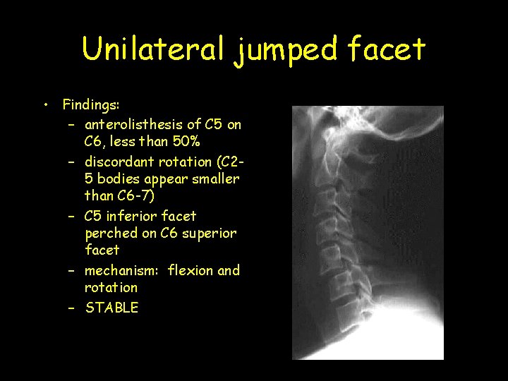 Unilateral jumped facet • Findings: – anterolisthesis of C 5 on C 6, less