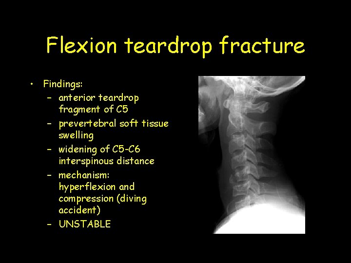 Flexion teardrop fracture • Findings: – anterior teardrop fragment of C 5 – prevertebral