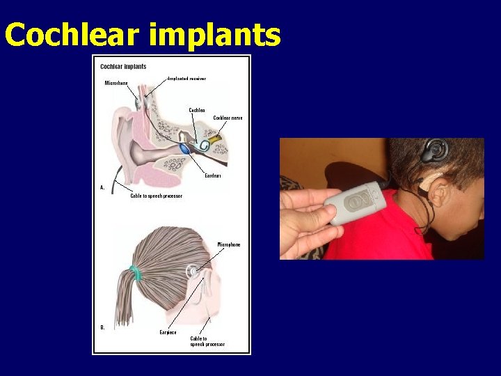 Cochlear implants 