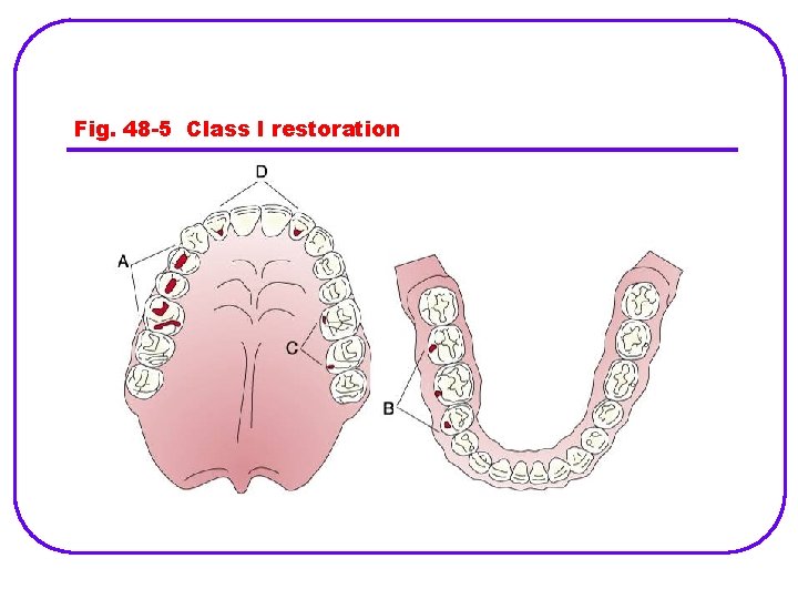 Fig. 48 -5 Class I restoration 