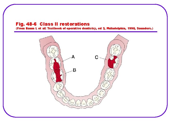 Fig. 48 -6 Class II restorations (From Baum L et al: Textbook of operative