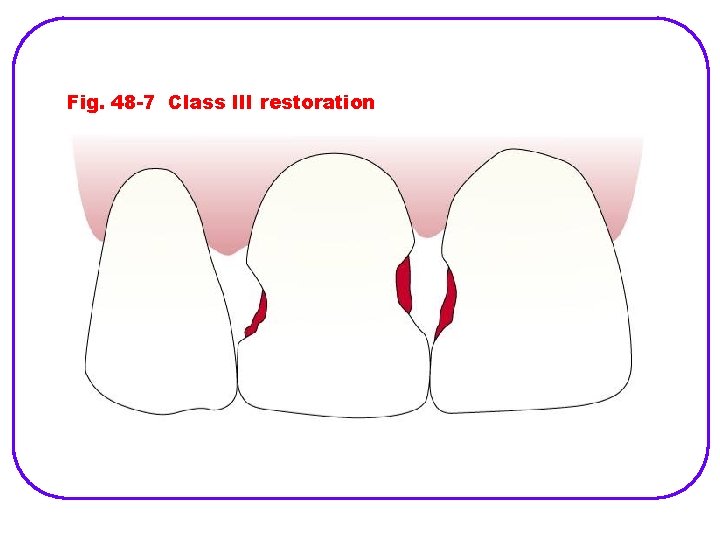 Fig. 48 -7 Class III restoration (From Baum L et al: Textbook of operative