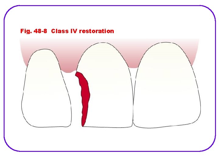 Fig. 48 -8 Class IV restoration (From Baum L et al: Textbook of operative