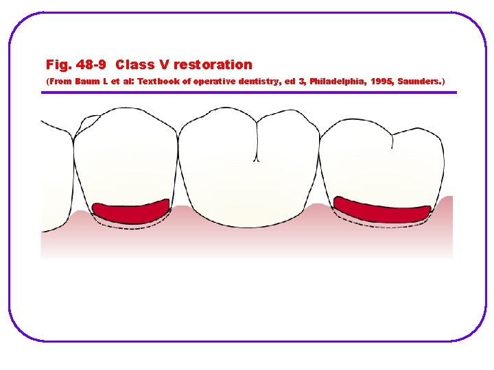 Fig. 48 -9 Class V restoration (From Baum L et al: Textbook of operative