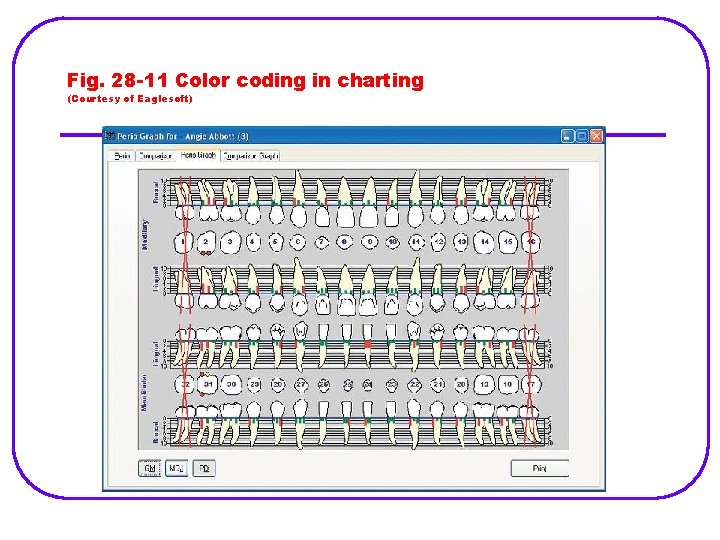 Fig. 28 -11 Color coding in charting (Courtesy of Eaglesoft) 